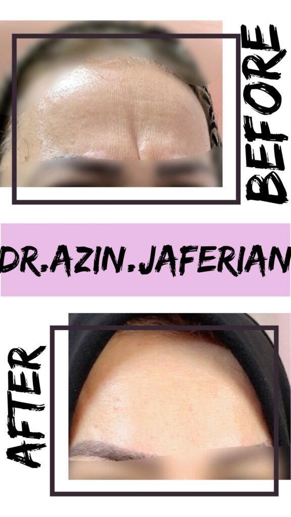 بوتاکس خط اخم