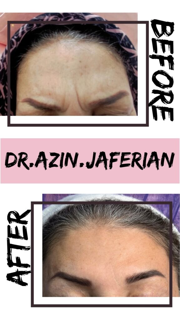 تزریق بوتاکس پیشانی و خط اخم + فیلر خط اخم