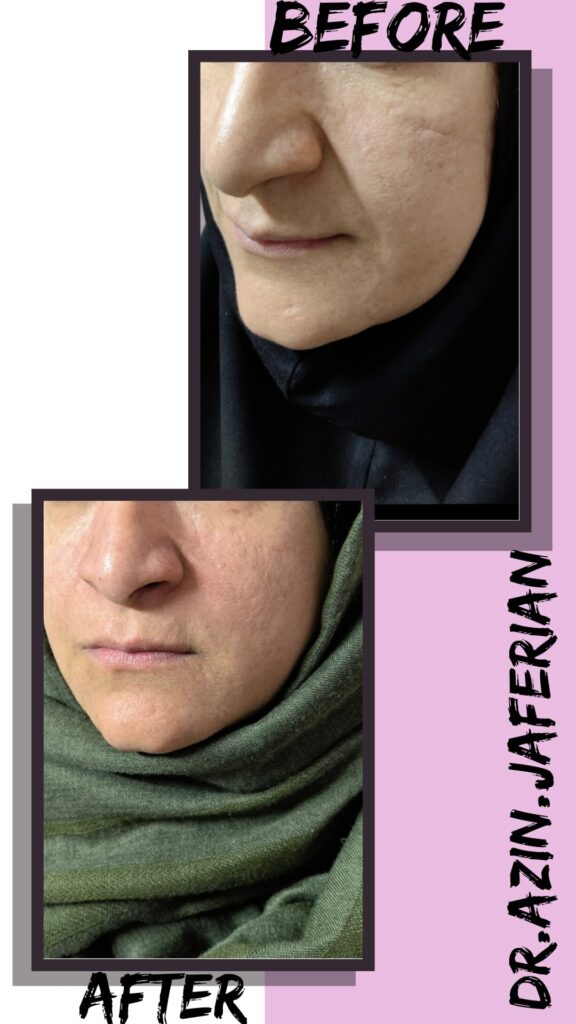 تزریق فیلر (ژل) خط لبخند و سیب گونه